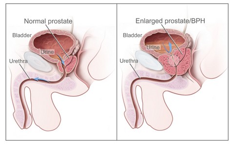 Prostataförstoring